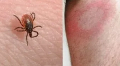 Kako se prenaša borelioza (bolezen lyme)?